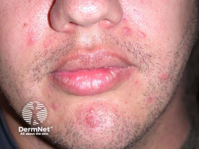Inflammatory acne example