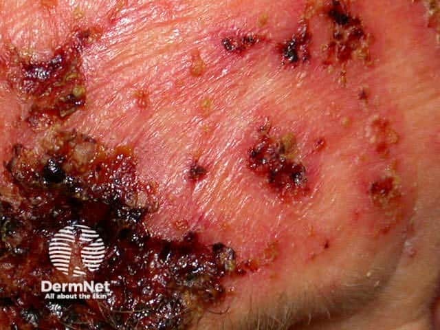 Skin cancer dermoscopy